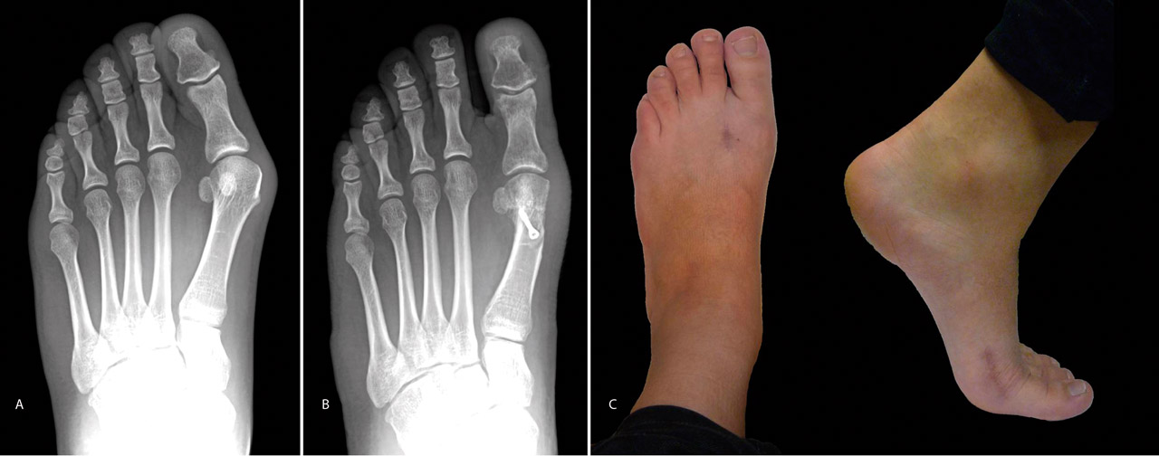 Деформация пальцев стопы мкб. Халюкс вальгус рентген. Остеомиелит 1 плюсневой кости. Перелом 3 плюсневой кости.
